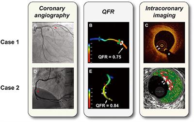 The Association Between Quantitative Flow Ratio and Intravascular Imaging-defined Vulnerable Plaque Characteristics in Patients With Stable Angina and Non-ST-segment Elevation Acute Coronary Syndrome